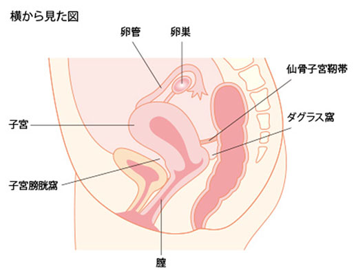 子宮内膜症　横から見た図